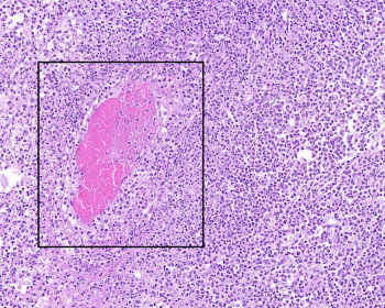 Acute vasculitis (box)